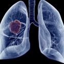 Lung cancer