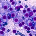 Multiple myeloma