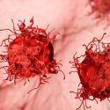 Skin cancer cells