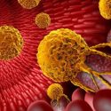 Colon cancer