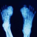 Chronic gout