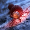 Cancer tumour