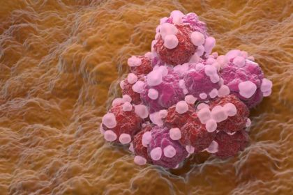 Ovarian cancer cells