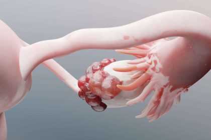 Ovarian cancer