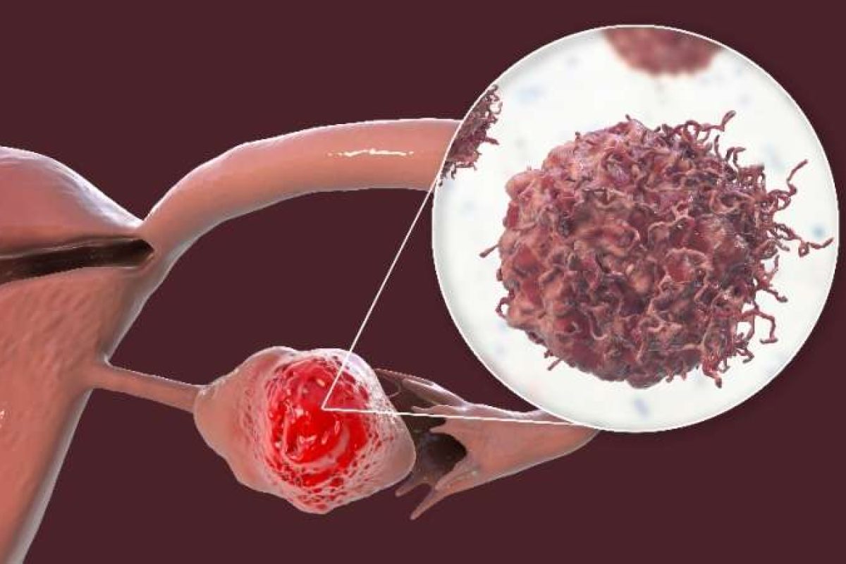 Ovarian cancer